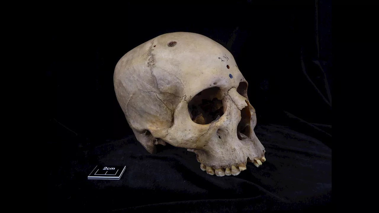 'Extraordinary' Skull Hints at Ancient Egyptian Cancer Treatment