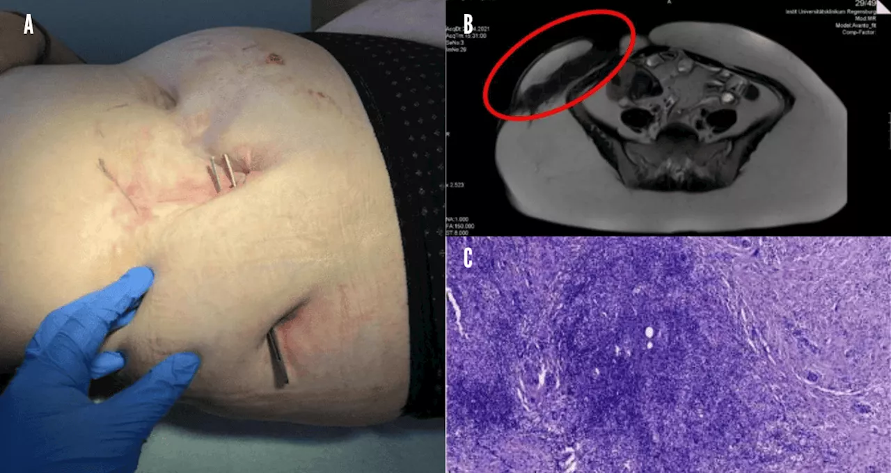 Fístulas conllevan a diagnóstico de Enfermedad de Crohn metastásica en paciente femenina