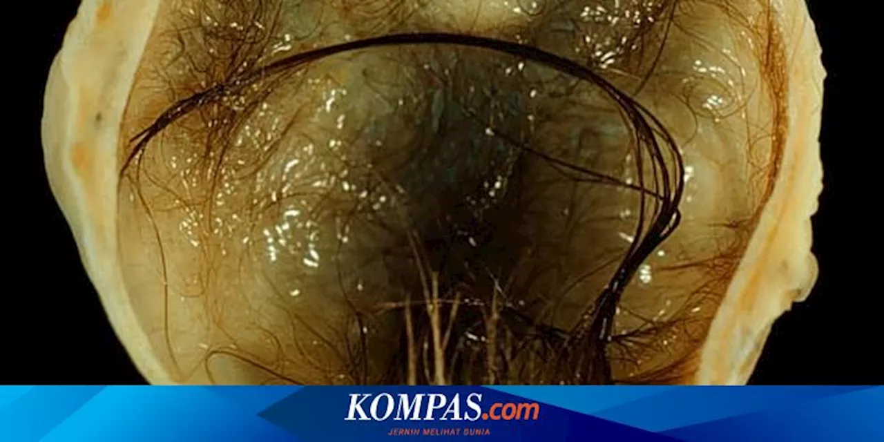 Tumor Disebut Bisa Menumbuhkan Gigi dan Rambut Sendiri, Benarkah?