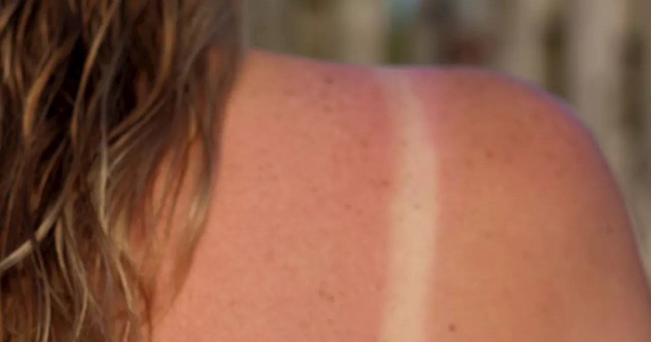 Met Eireann warns of mixed weather and risk of sunburn for the Bank Holiday