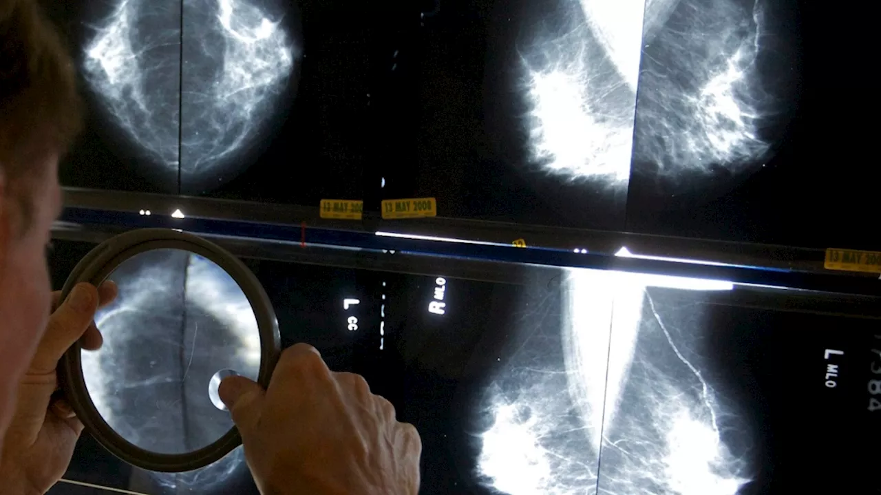 National task force not lowering age for routine breast cancer screening to 40