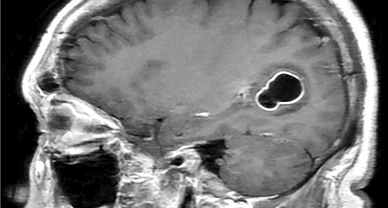 Implante bilingüe: Chip con IA permite a paciente con parálisis cerebral comunicarse en inglés y español