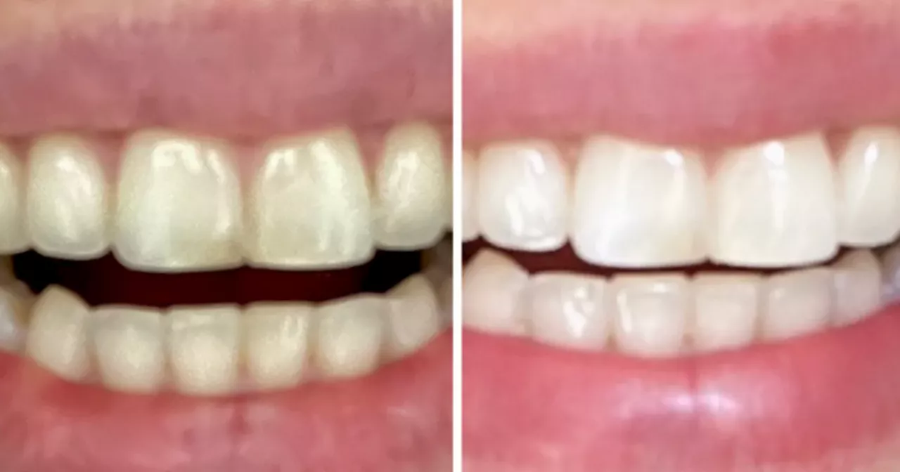 Shoppers insist 'brilliant' £25 teeth whitening solution erases years of stains