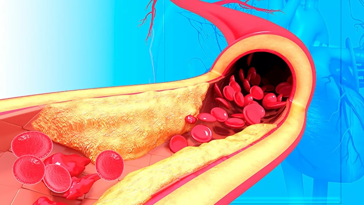 Primary Sjögren Disease Promotes Premature Atherogenesis