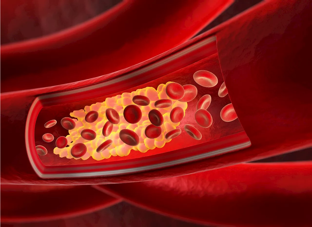 RNA interference agent plozasiran targets APOC3 for effective mixed hyperlipidemia treatment