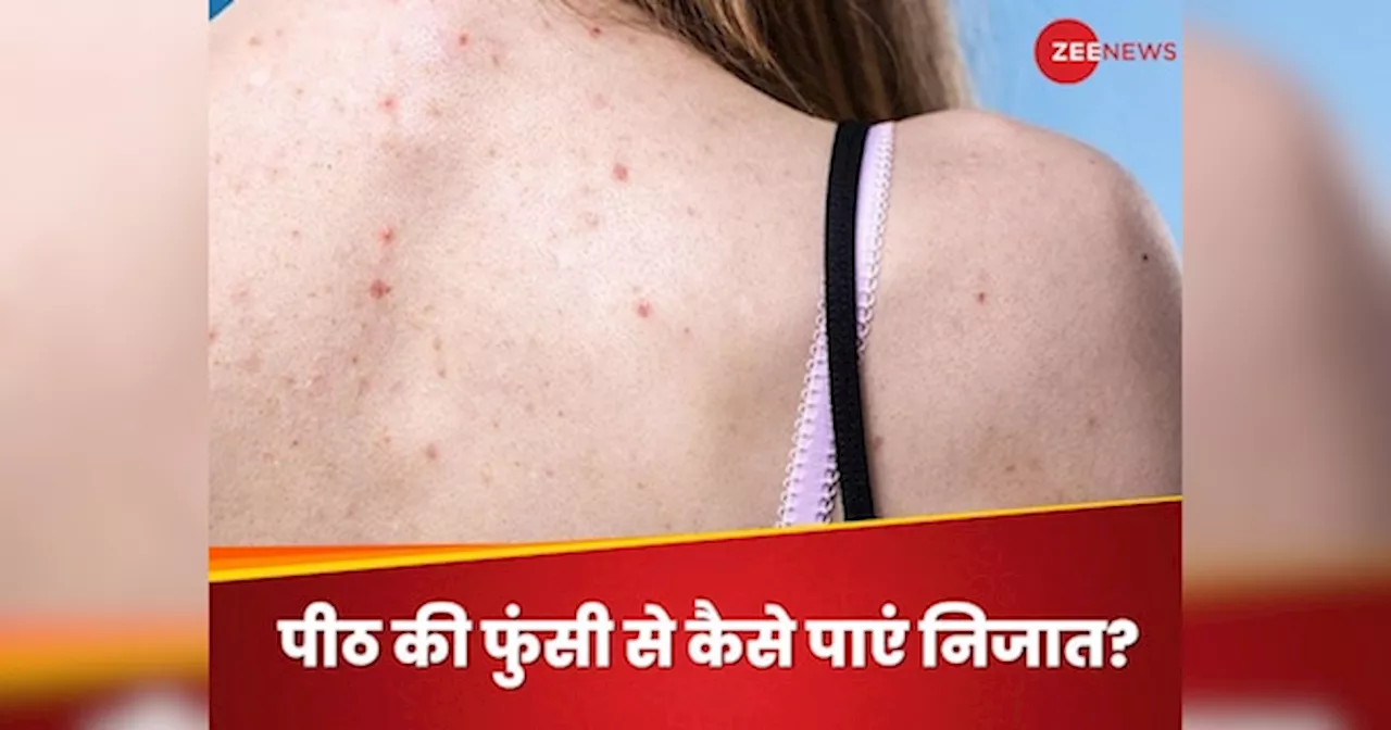 Back Acne: पीठ की फुंसी के कारण नहीं पहन पा रही हैं बैकलेस ड्रेस? इन चीजों की मदद से दूर करें दाने