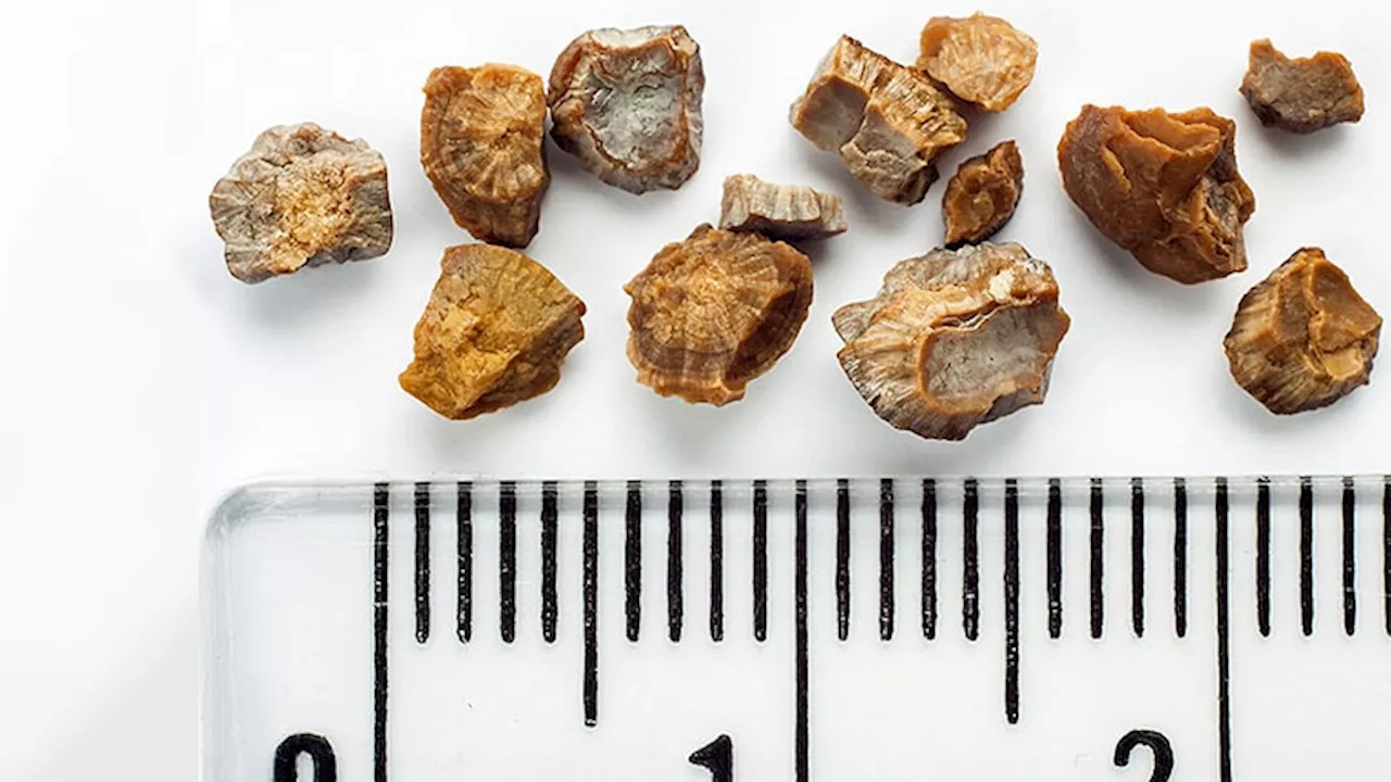 Office Procedure Found to Get Stone Fragments Rolling