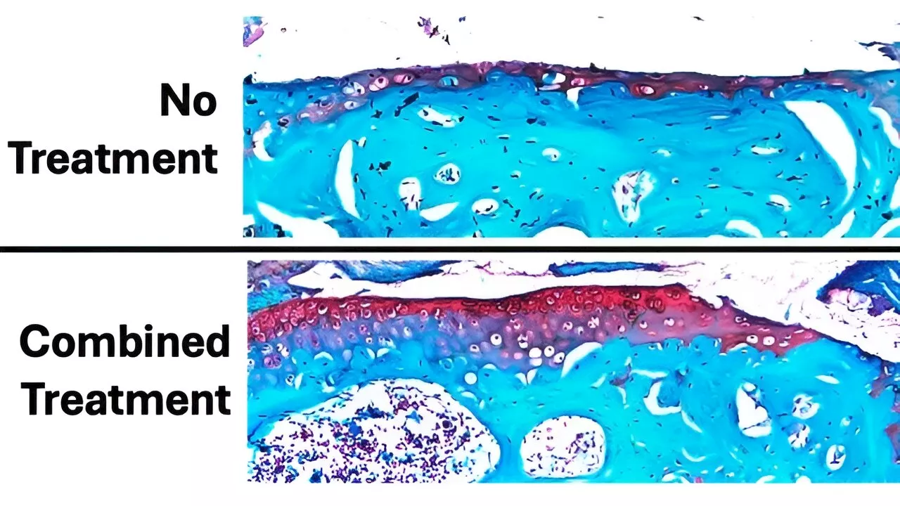 Parathyroid hormone treatment helps slow development of osteoporosis, researchers find