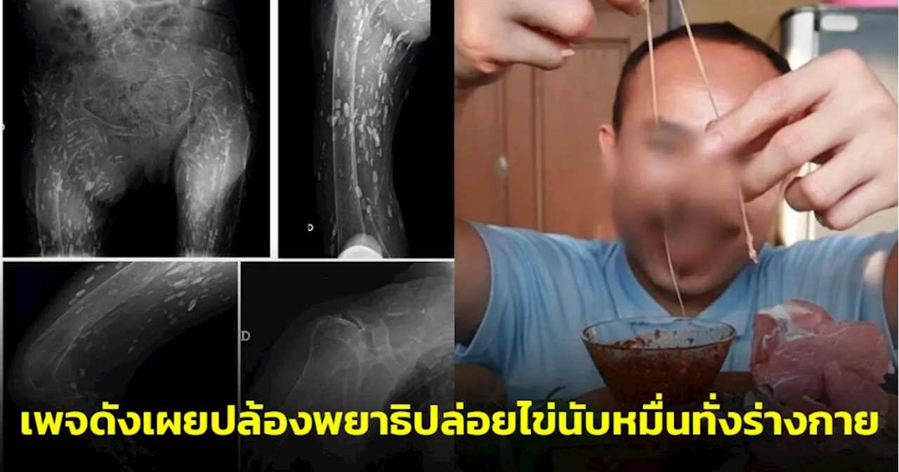 เพจดังอธิบายชัด หลังอินฟลูฯกิน “พยาธิตัวตืด” โชว์ เผยปล้องพยาธิปล่อยไข่นับหมื่นทั่งร่างกาย