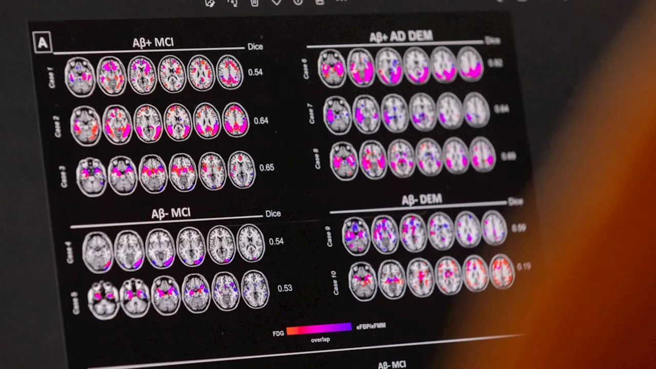 Discovery of new Alzheimer’s gene risk could lead to earlier interventions