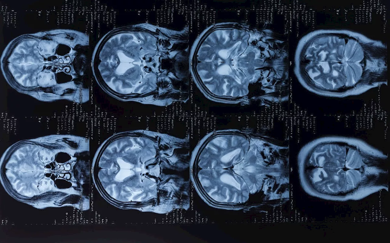 Alzheimer-Studie: Genvariante für Erkrankung verantwortlich