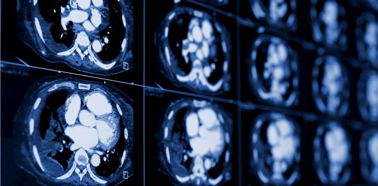 Lung Cancer Is The Deadliest, Screening Could Save Many Lives