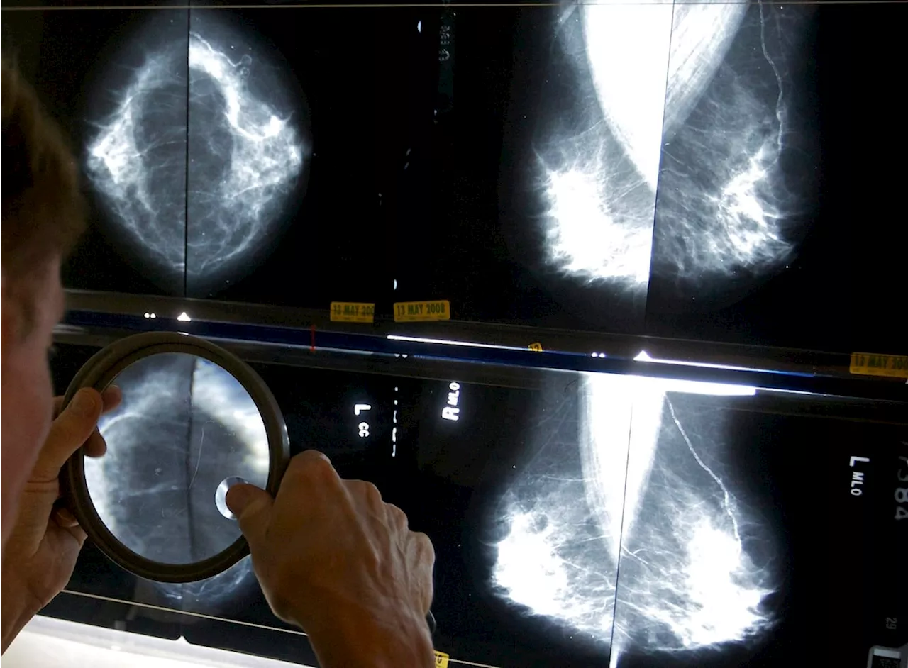 Breast cancer screening should start at age 40, Canadian Cancer Society says