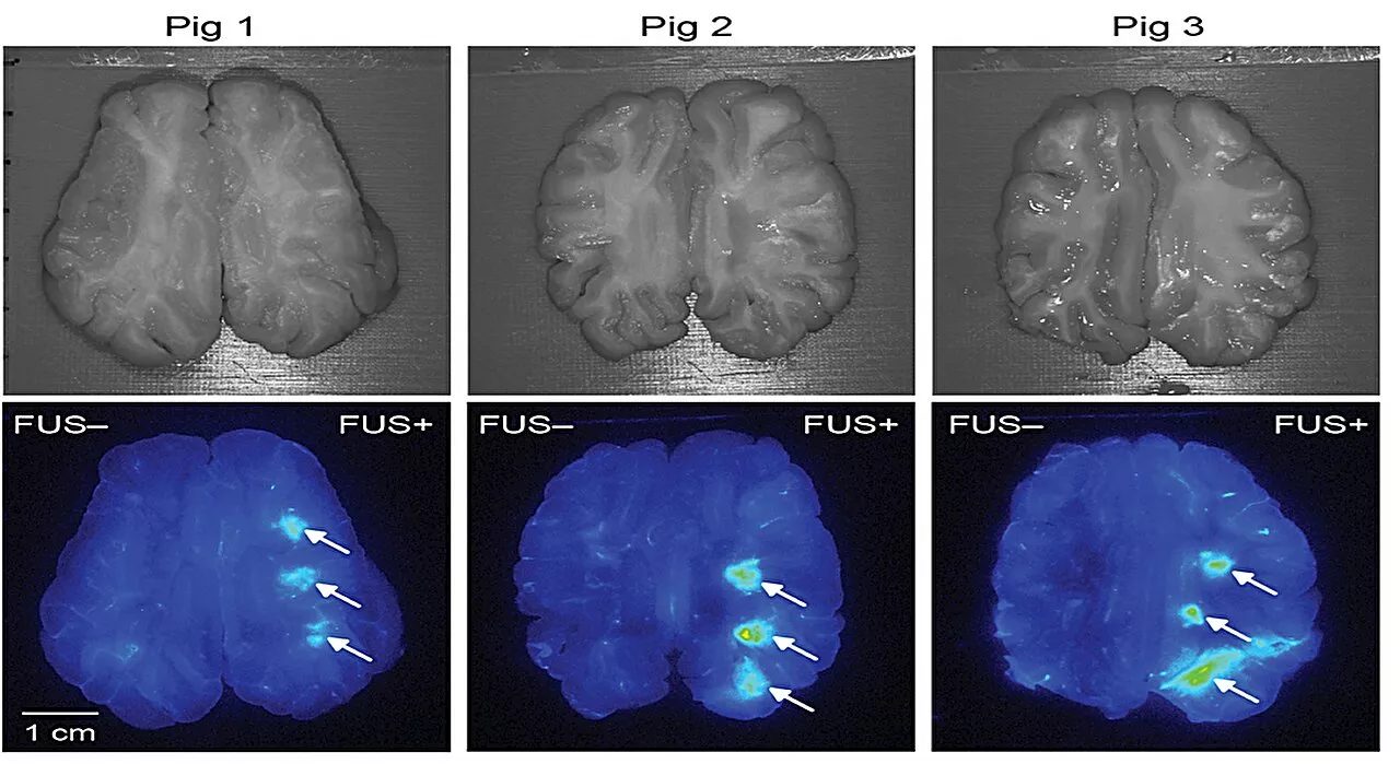 How ultrasound and microbubbles could deliver immunotherapy to the brain