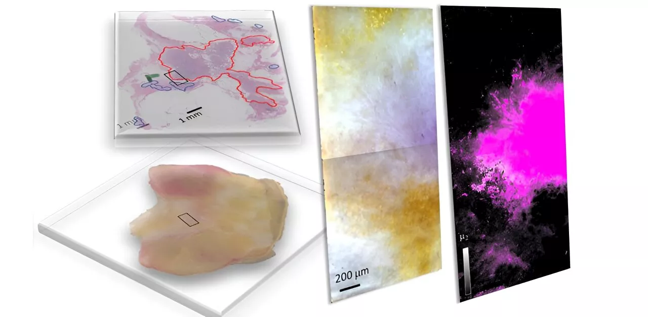 Study introduces hyperspectral dark-field microscopy for rapid and accurate identification of cancerous tissues