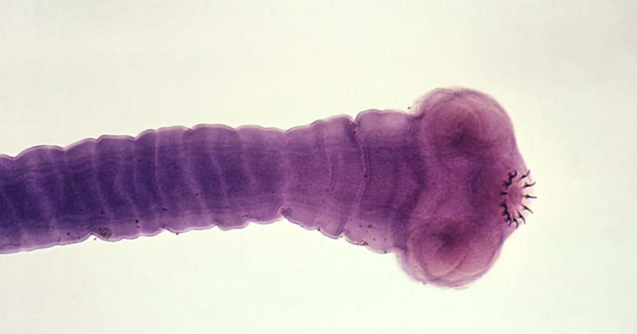 What to know about pork tapeworms in the brain, after RFK Jr. said he got a parasitic infection