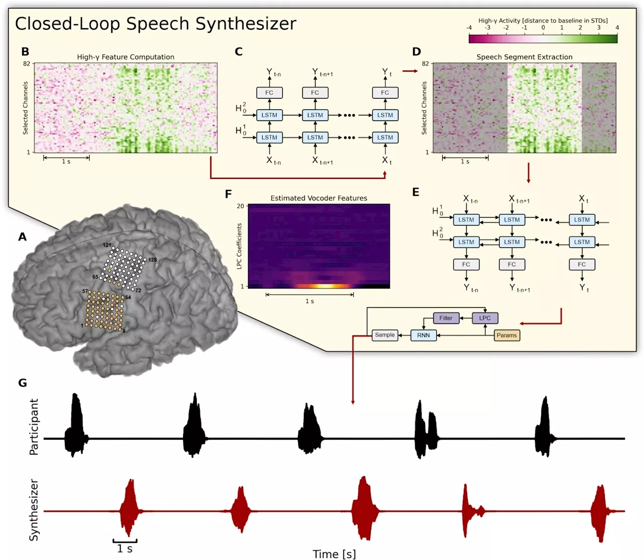 Brain-computer interface translates ALS patient's brain activity into spoken words