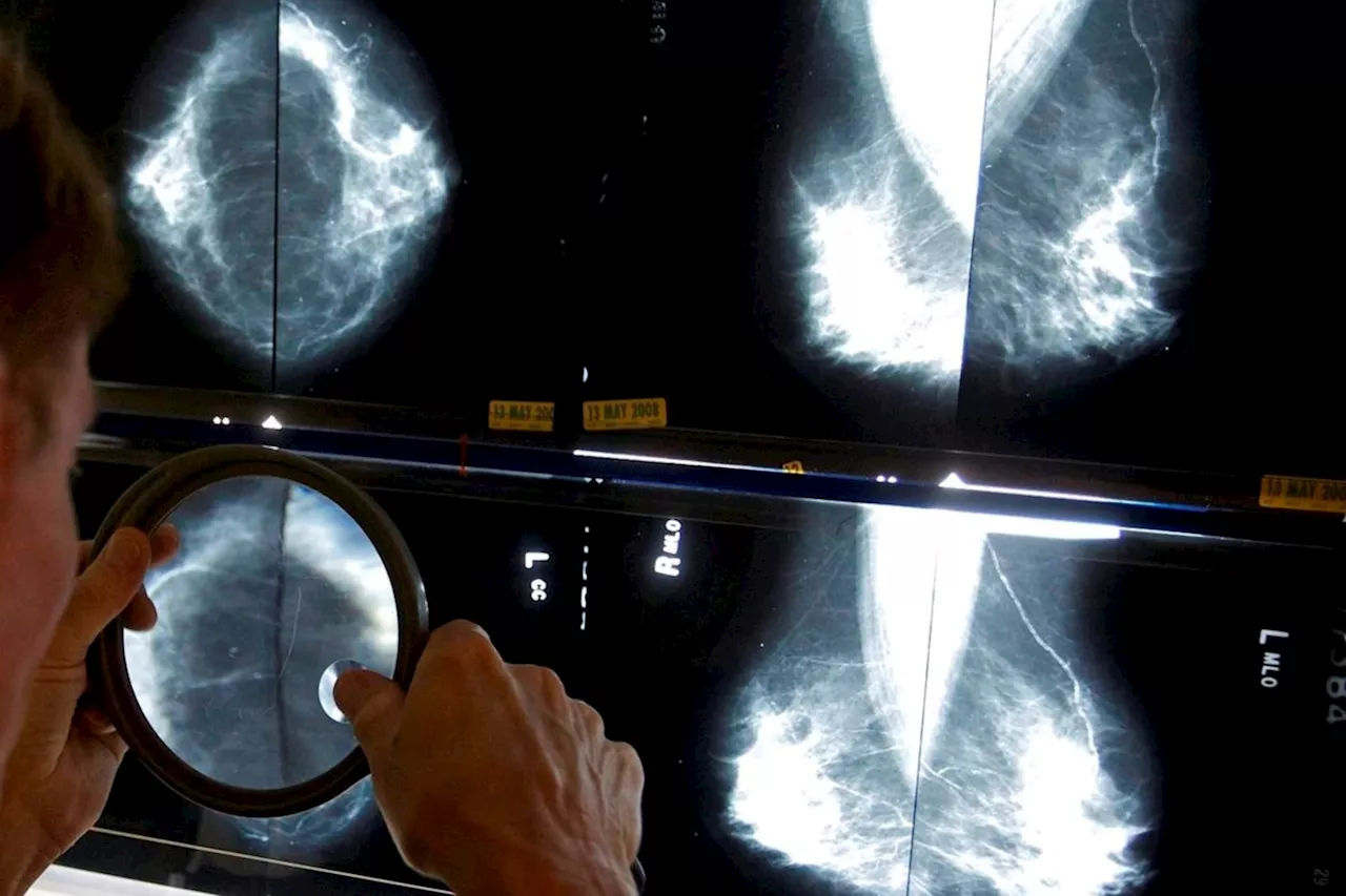 Breast cancer screening should start at age 40, Canadian Cancer Society says