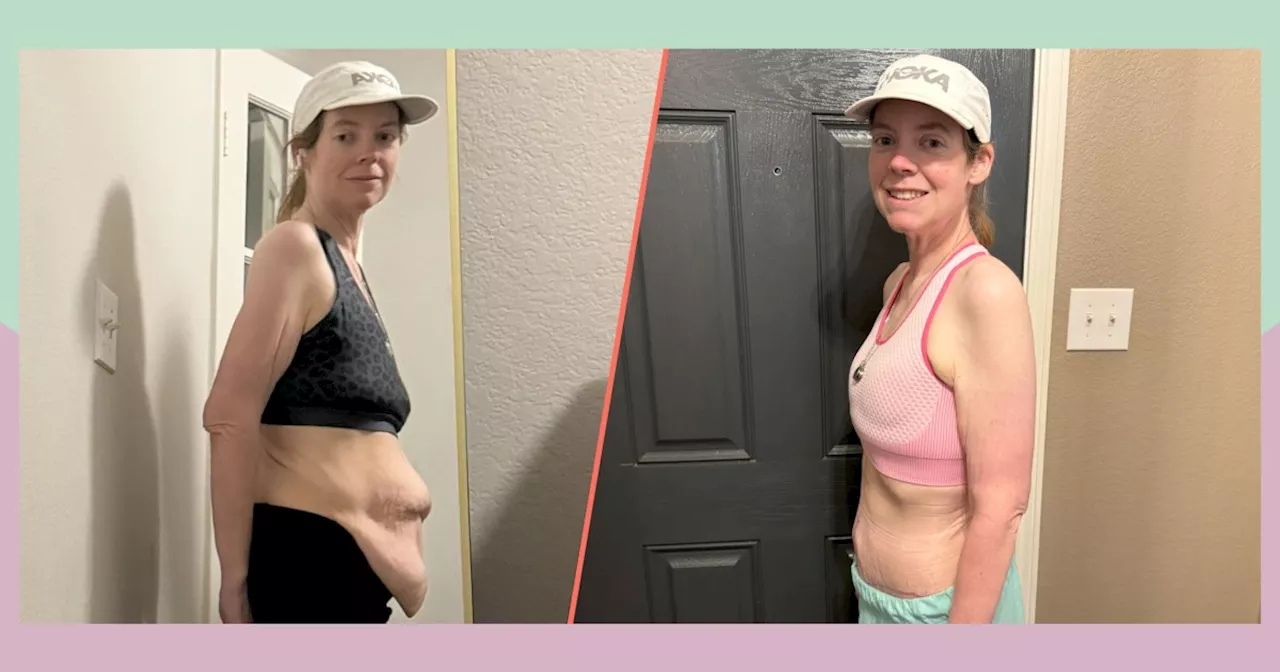 Mom Loses 210 Pounds, Has Skin Removal Surgery for Loose Skin