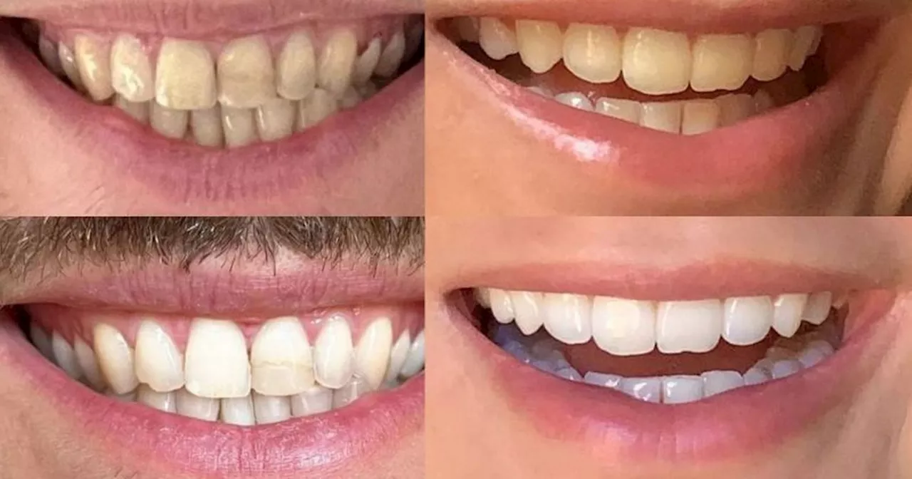 Little known code will save you money on 'game changing' teeth whitener