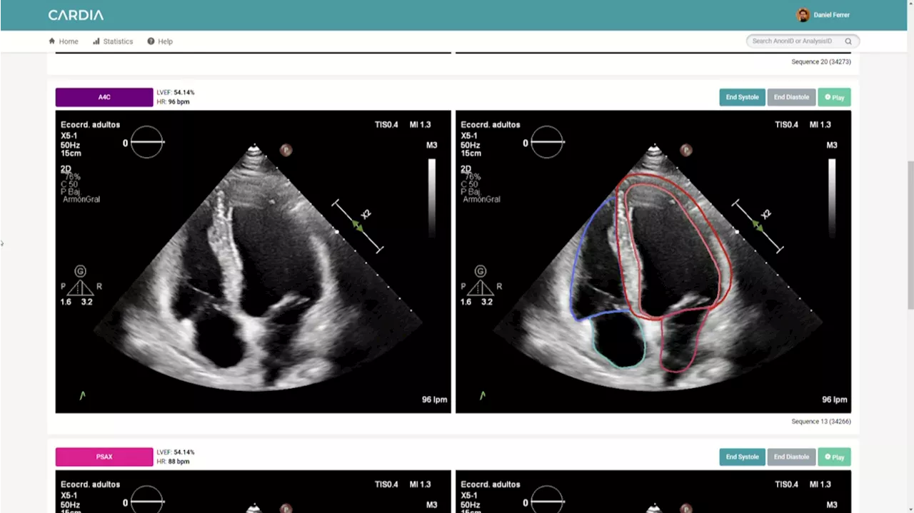 Una empresa española crea una tecnología con IA para detectar cardiopatías