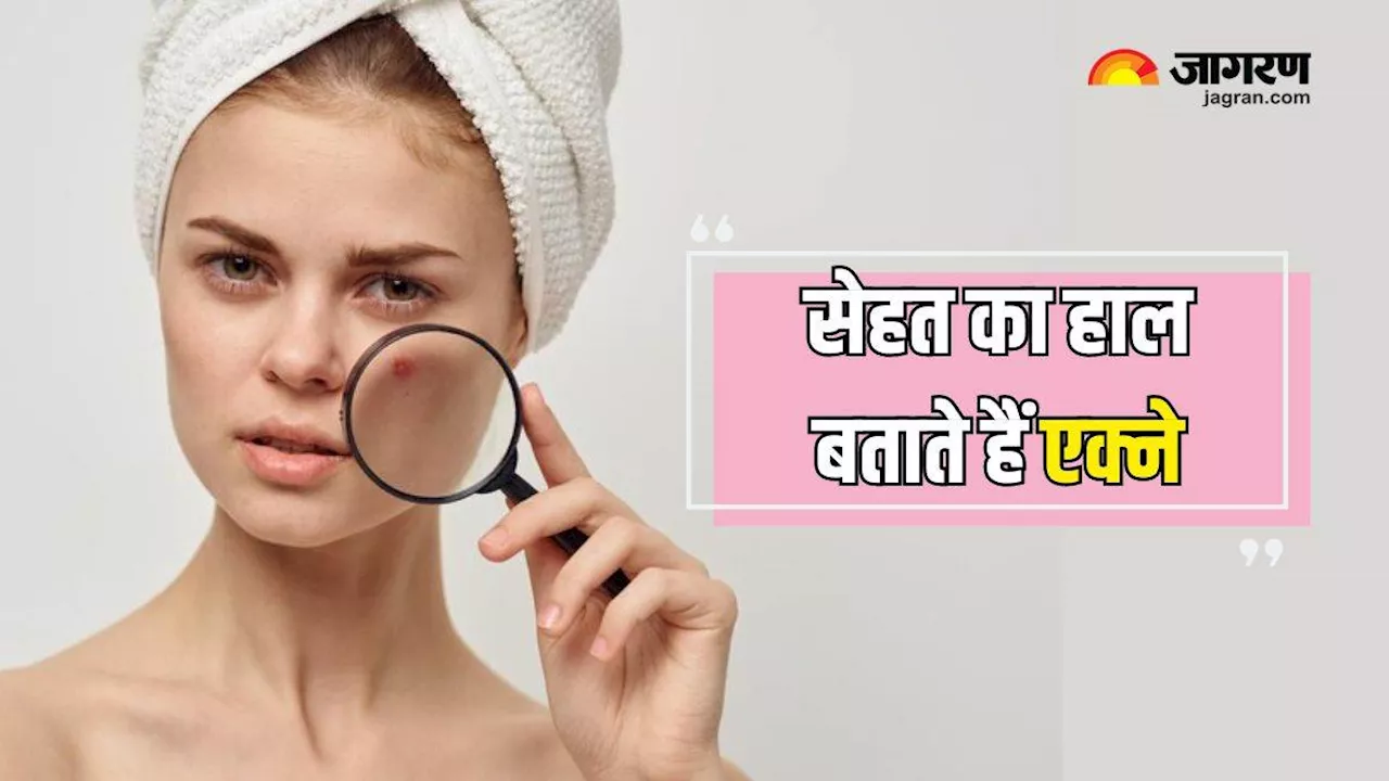 चेहरे पर होने वाले Acne करते हैं सेहत का हाल बयां, एक्सपर्ट से जानें किन समस्याओं की ओर करते हैं इशारा