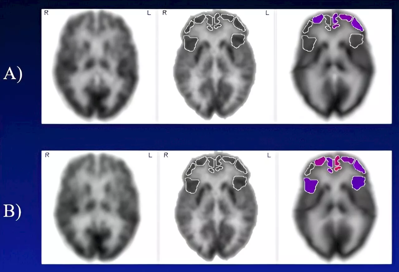 Hearing aids help to slow the brain aging process in adults with mild cognitive impairment