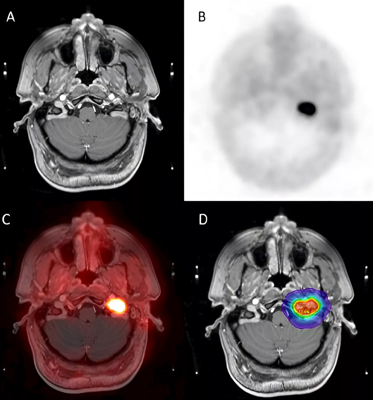 PET/CT provides superior lesion detection for head and neck paragangliomas compared to gold standard MRI