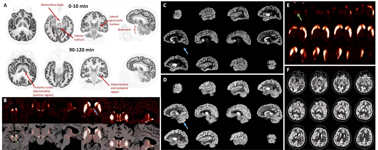 Ultra-high-resolution PET provides never-before-seen images of the brain