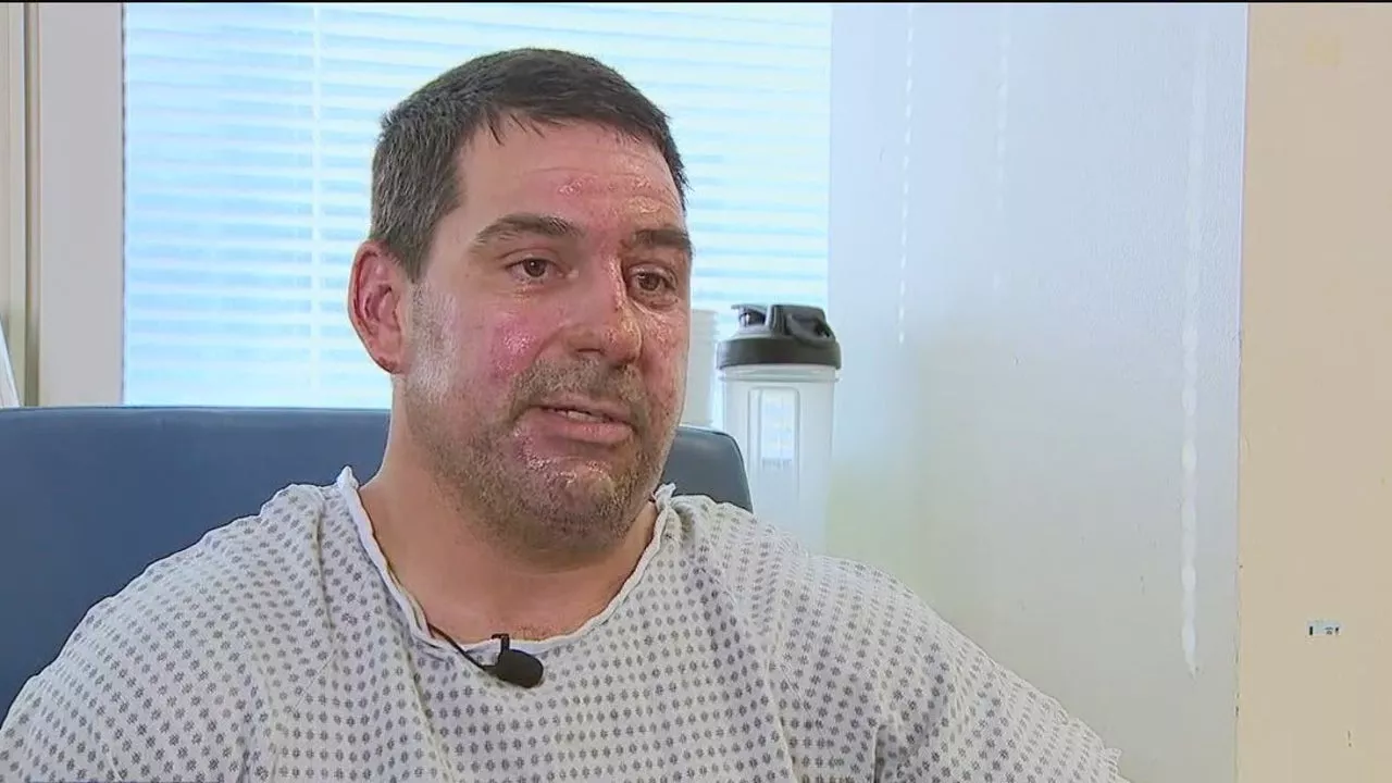 Alameda County firefighter injured in Corral Fire faces 2nd surgery