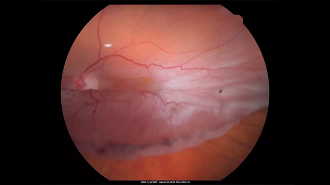 Axial Length and Residual Capsule Predict Retinal Detachment After Lens Removal in Marfan