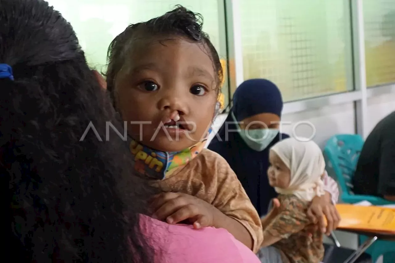 Ketahui apa itu bibir sumbing dan lelangit serta cara pengobatannya