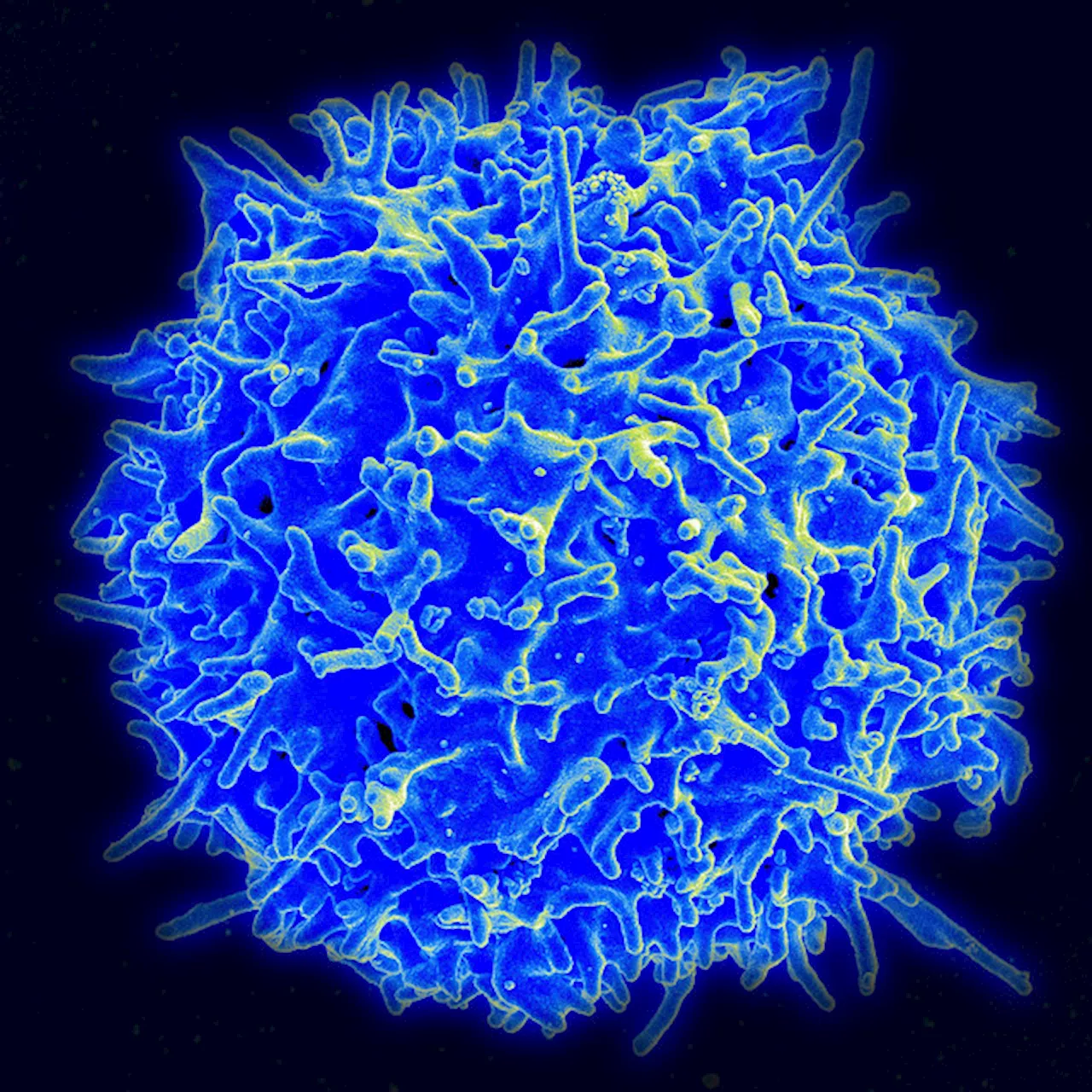 Risk of secondary cancers after CAR-T cell therapy low, according to large study