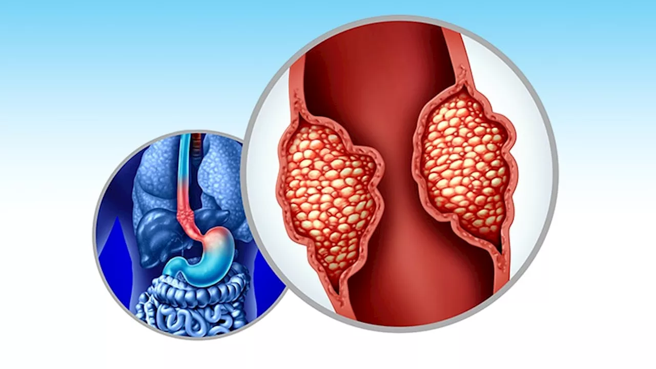 ESOPEC: FLOT Bests CROSS in Resectable Esophageal Cancer