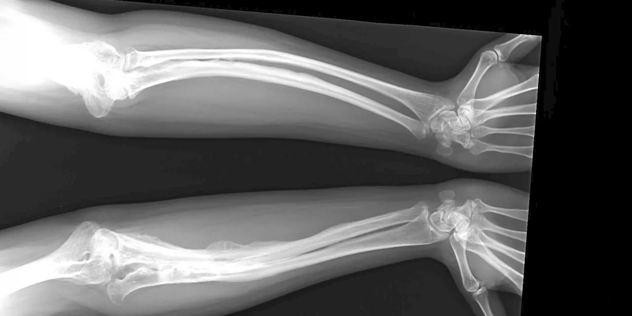 Gaining a better understanding of brittle bone disease with 3D model featuring biodegradable hydrogel matrix