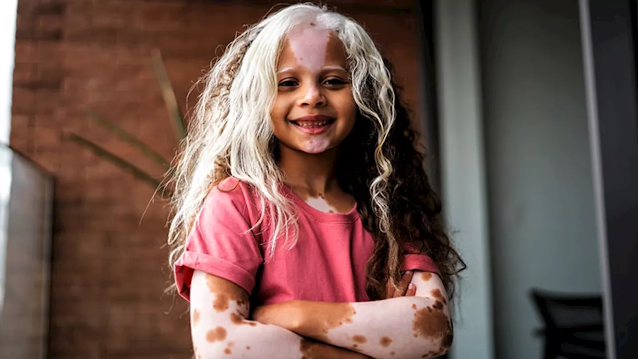 Congenital Pigment Disorders May Need Special Management