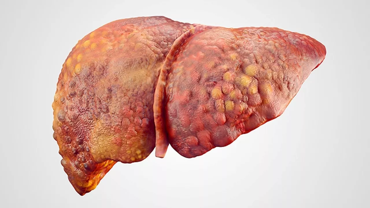 Significant Benefit With Liver Transplantation in ACLF: CHANCE Study