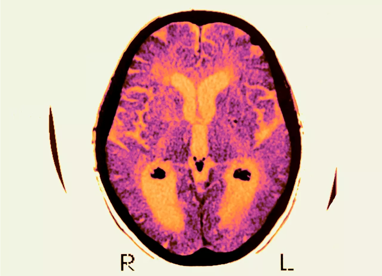 Alzheimer’s Drug with Modest Benefits Gets Green Light from FDA Advisers