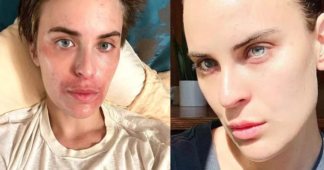 Tallulah Willis, la fille de Demi Moore et Bruce Willis, dévoile sa peau au naturel dans un avant/après bluffant