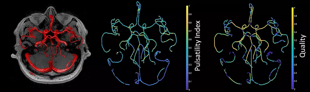New metric for blood circulation in brain to better understand dementia