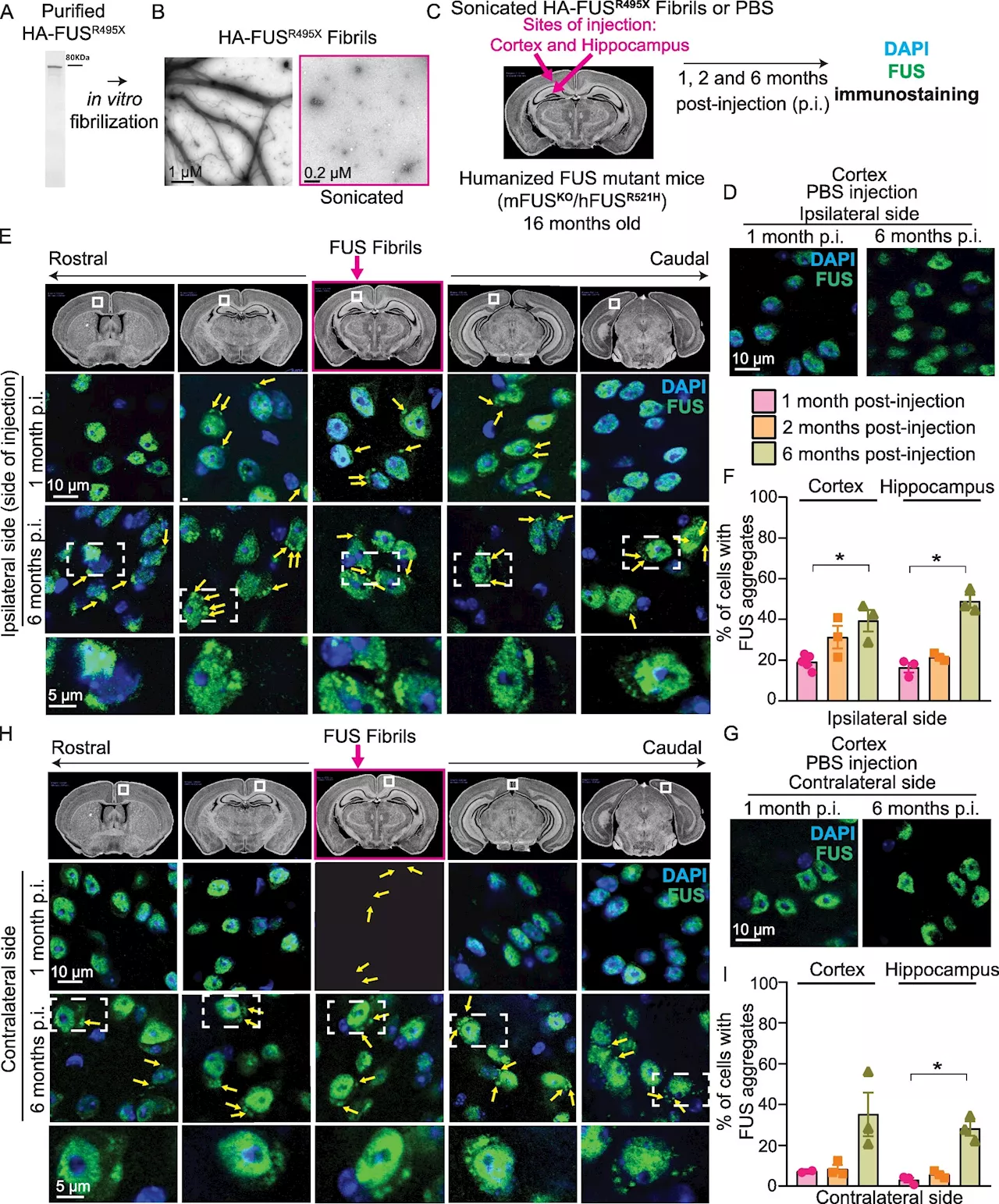 Study reveals FUS protein's role in two neurodegenerative diseases