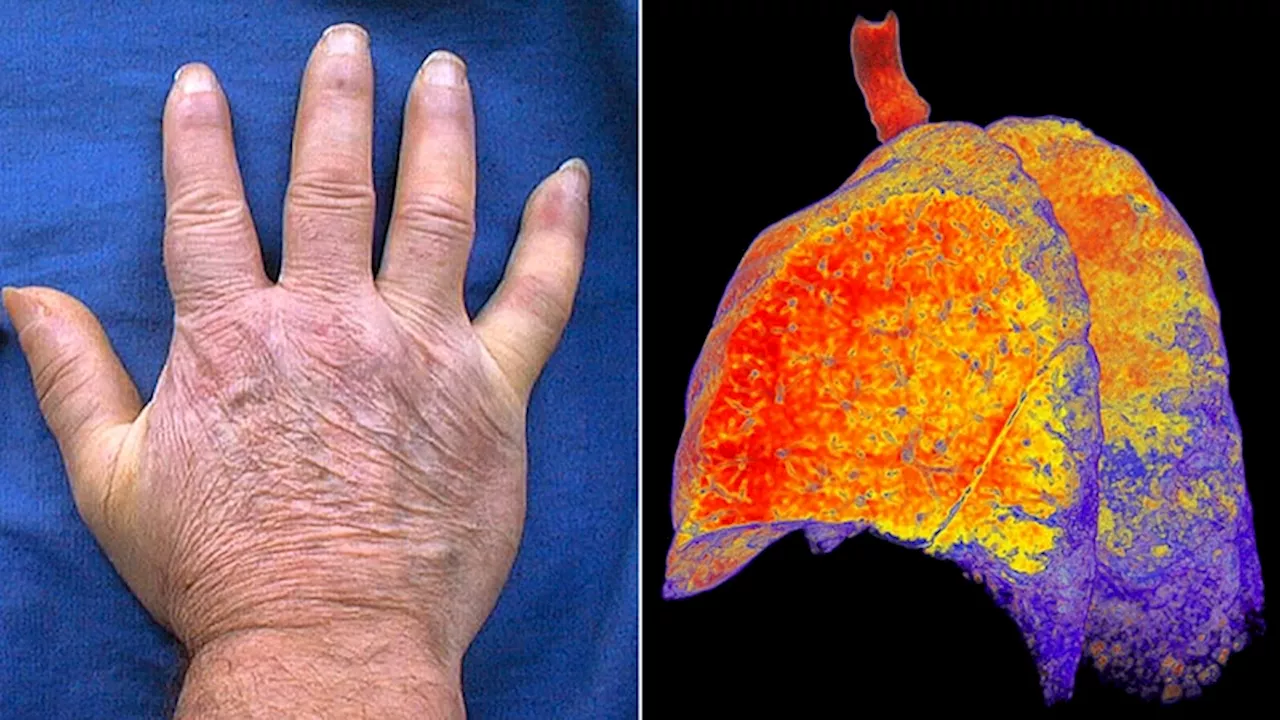 Anti-Ro/SSA Antibodies Have Potential to Predict ILD in Systemic Sclerosis