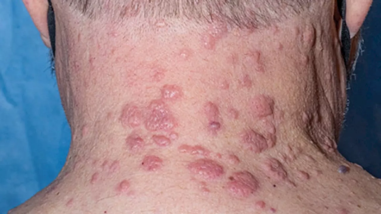 Study Elucidates Skin Signs of VEXAS Syndrome