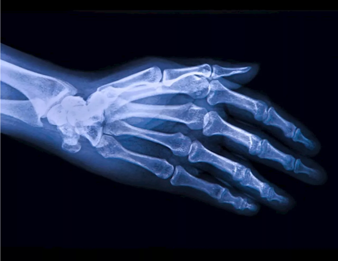 Exploring the comorbidities associated with osteoarthritis