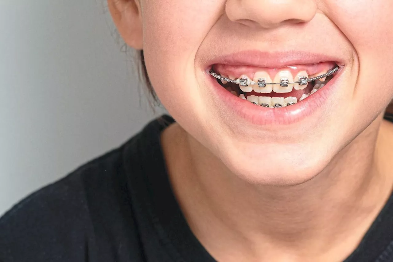 What to know about getting braces for your kid