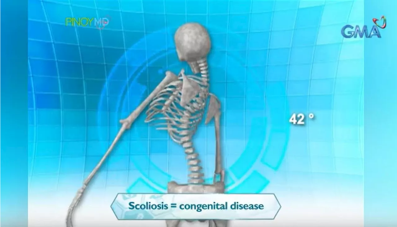 DOH: Early detection needed for scoliosis treatment