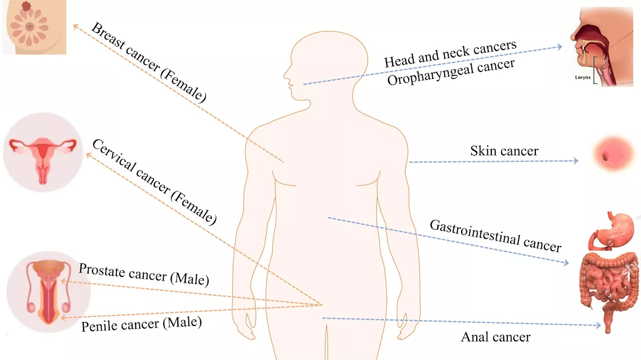 Team reports on prevalence in Middle East of cancers associated with human papillomavirus