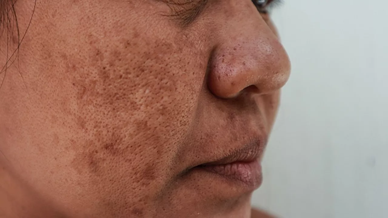 Oral Tranexamic Acid Boosts Melasma Outcomes With Topical Combination Cream