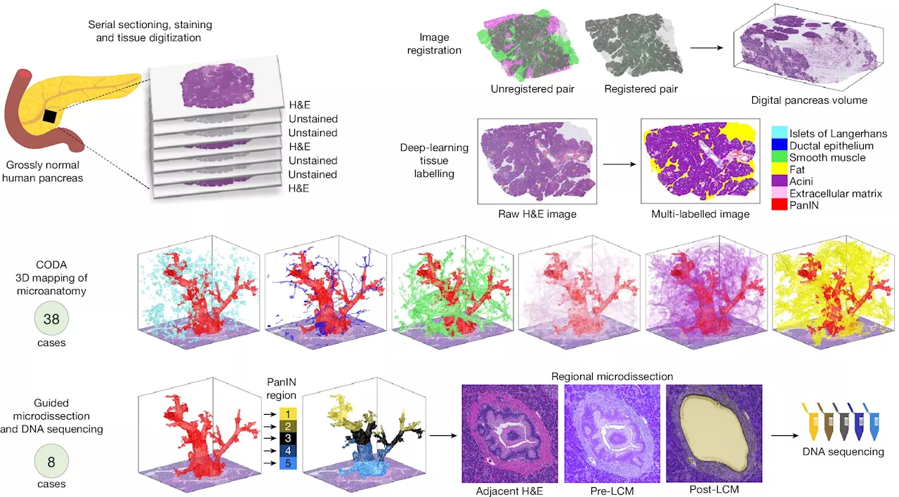 New 3D technique reveals precancerous pancreatic lesions