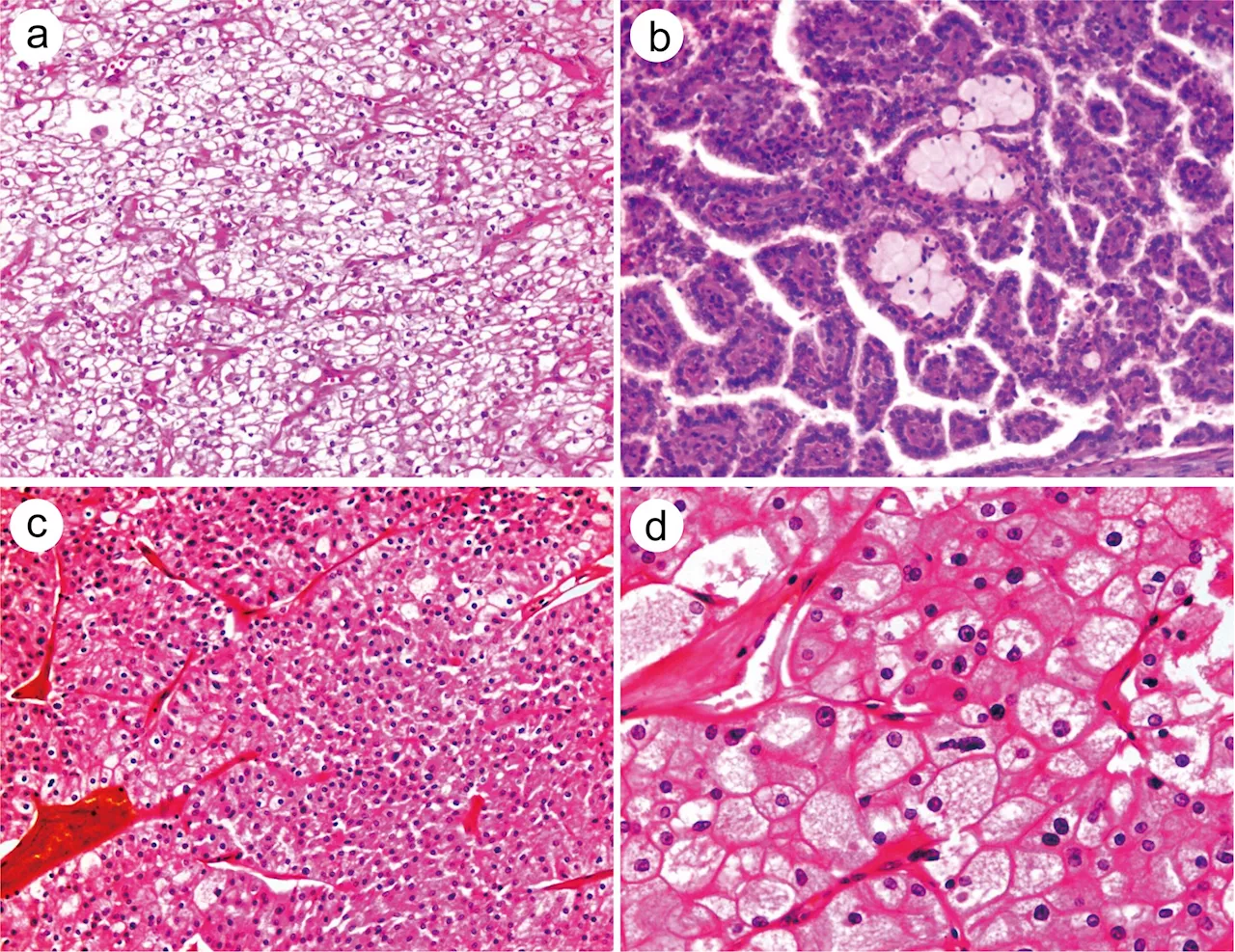 Updates from the 2022 WHO classification of kidney epithelial tumors